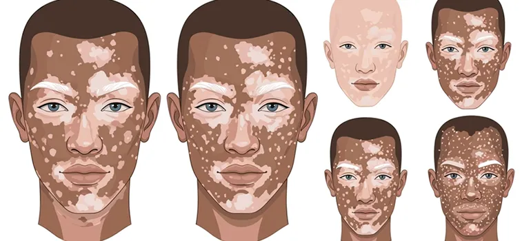 Excimer Phototherapy Treatment